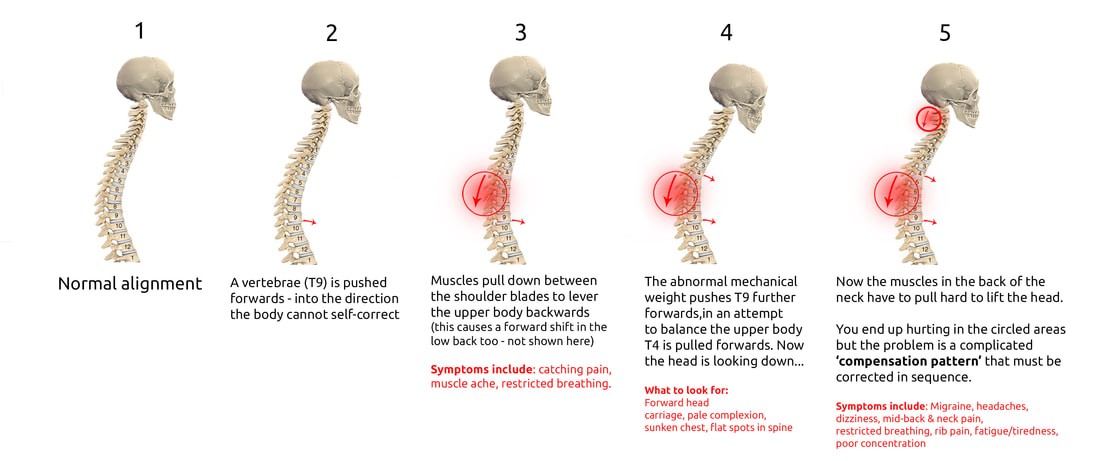 Progression of structural complications with one bone going out of place in a direction the body can not self-correct
