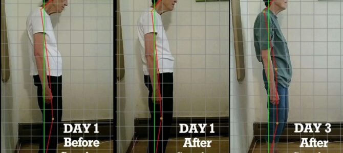 Client image showing significant improvements in posture over the first three treatments