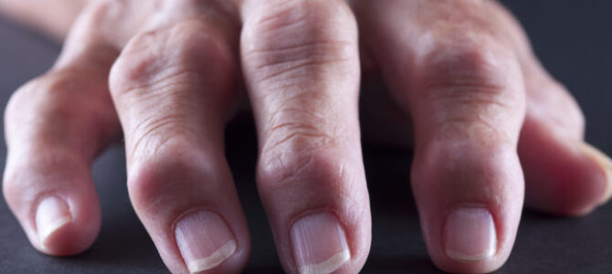 Selective-focus image of arthritic adult hand shot on black