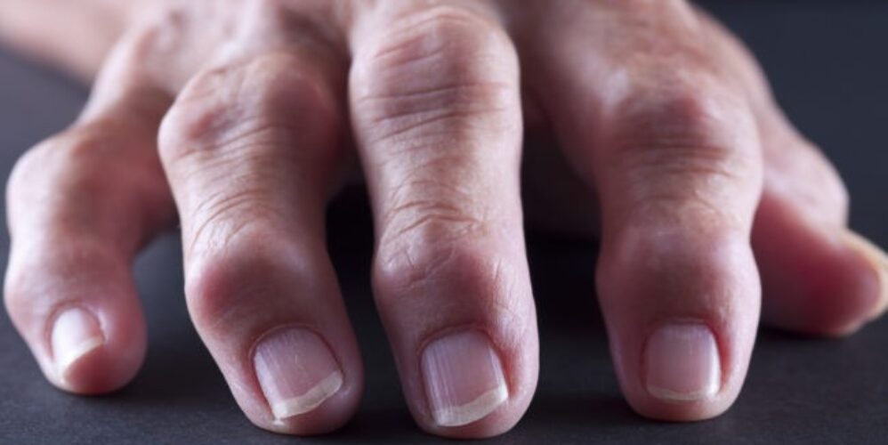 Selective-focus image of arthritic adult hand shot on black