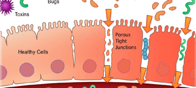 Graphic illustrating both healthy and unhealthy epithelial cells in a leaky gut